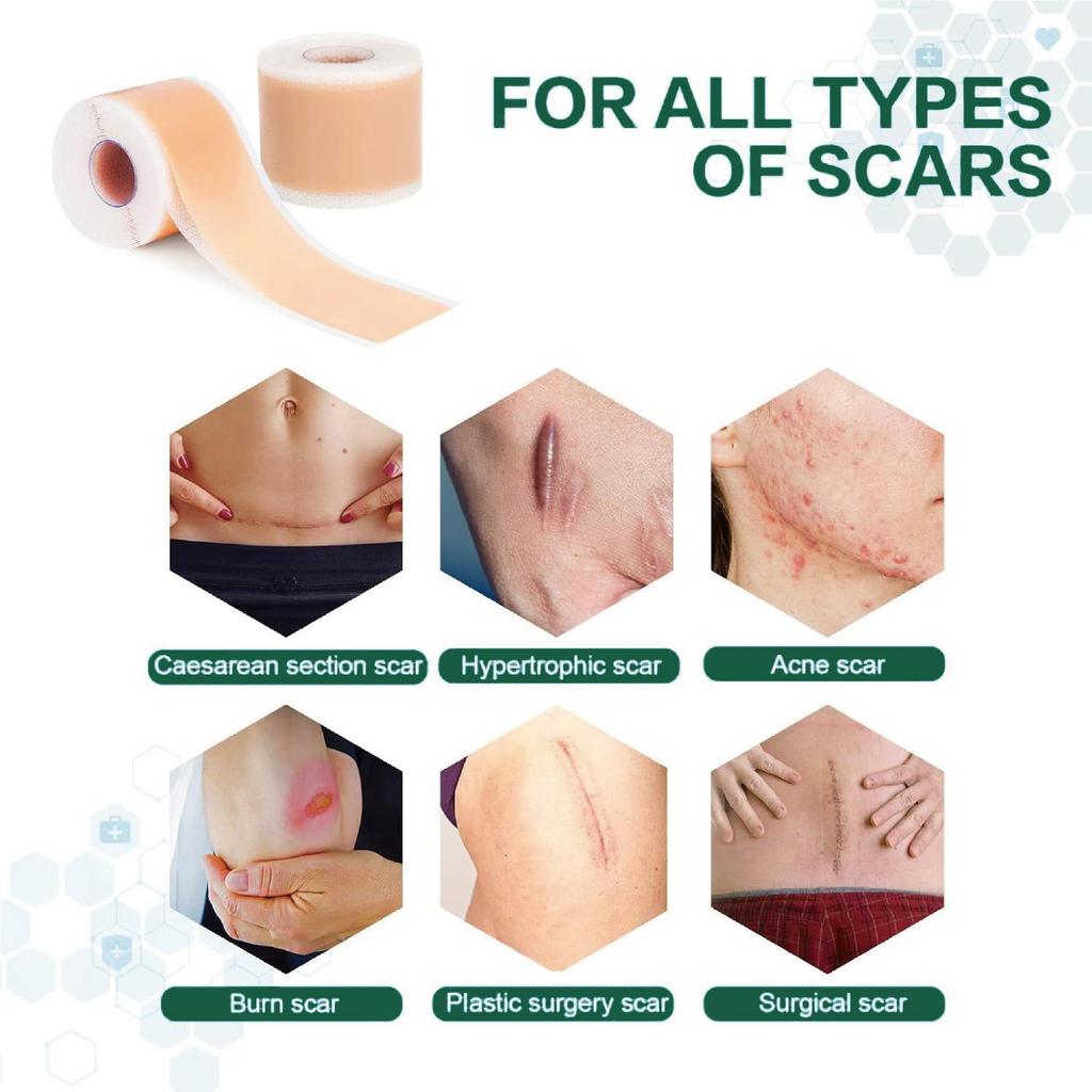 Adjustable Silicone Gel Scar Sticker Roll for Surgical Scar Repair