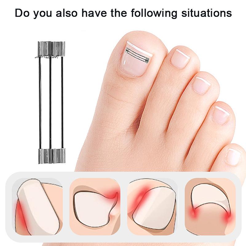 1 Set Professioneller eingewachsener Zehennagel Korrekturclip Spange Pediküre Erholungswerkzeug zur Zehennagelbehandlung Einwachsen Begradigungswerkzeug