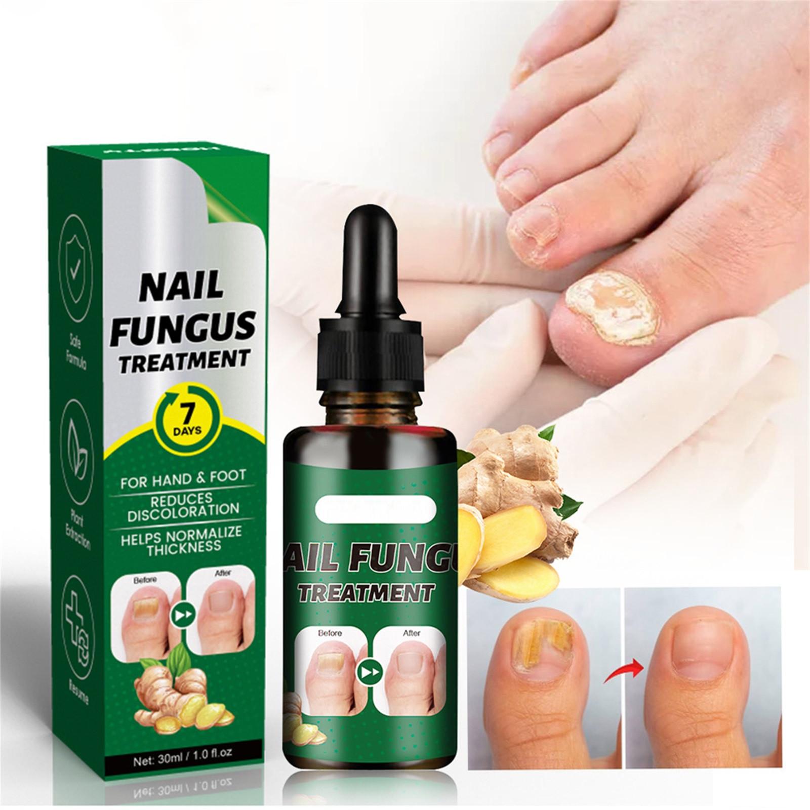 

Toenail Fungus Care, быстродействующая жидкость для ухода за ногтями от грибка под и вокруг, восстанавливает здоровый вид ногтей 30 мл