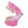 Dental Implant Model Teaching Aid for Dentist Student School Removable Teeth