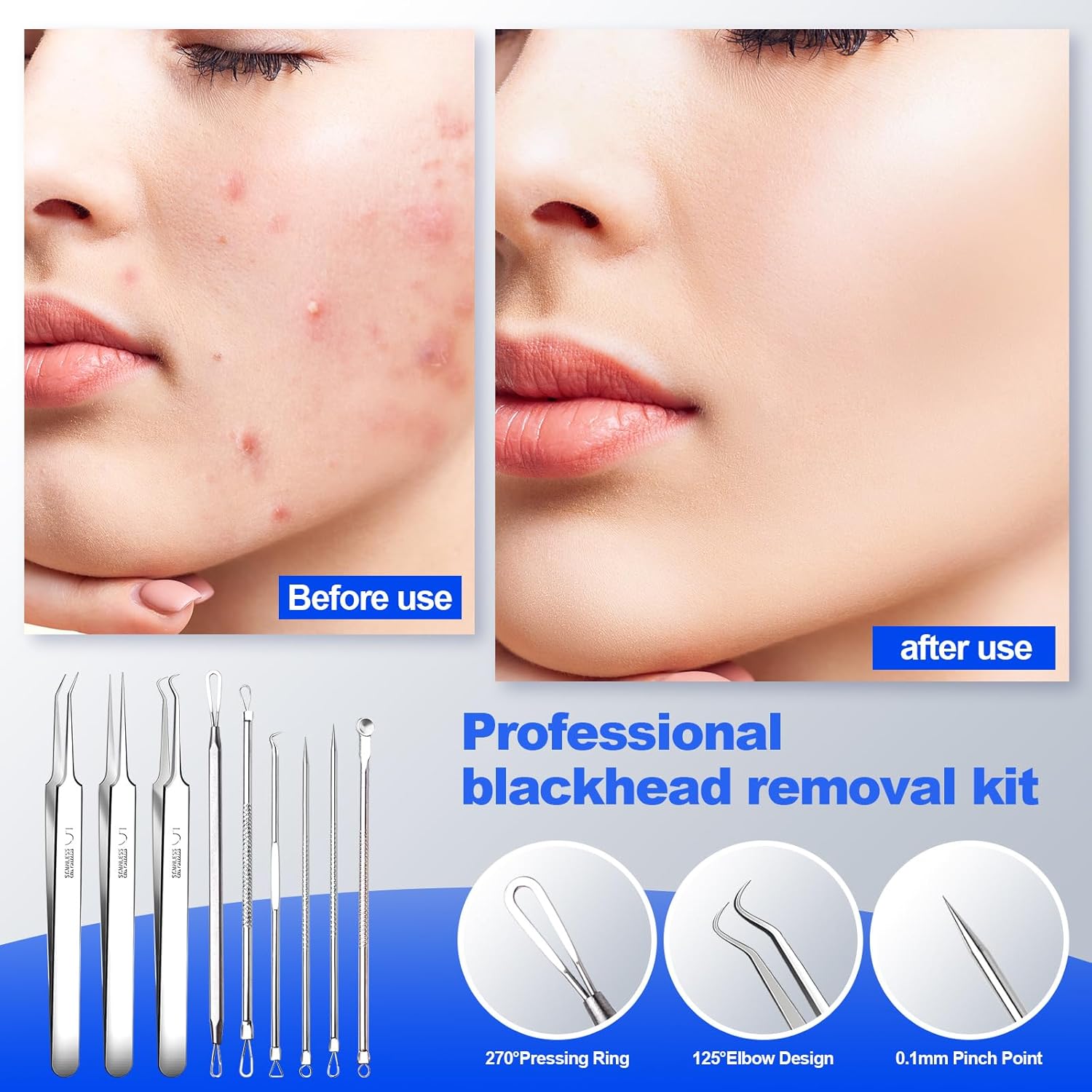Blackhead Remover Pimple Popper Tool Kit 10PCS Professional Stainless Steel Blackhead Tweezers,Pimple Extractor for Removing Pimples, Zit on Face -