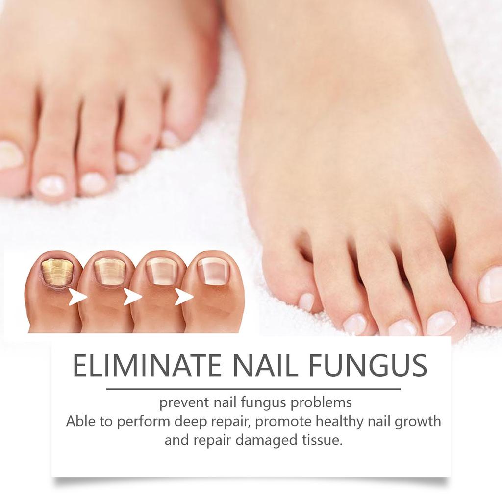 Nagelreparaturstift Feuchtigkeitsspendende Behandlung für verfärbte weiche dicke Nägel Hand-Fußpflege Tragbar Sanfte Formel