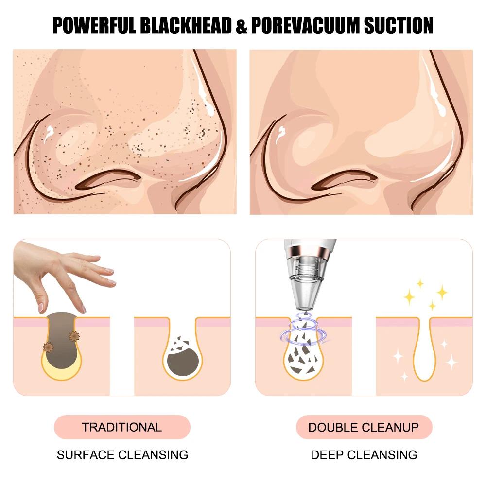 Beauty Instrument 6 Nozzle Facial Vacuum Pore Cleaner. Instrument for cleaning pores and blackheads. Instrument for facial cleansing and exfoliation