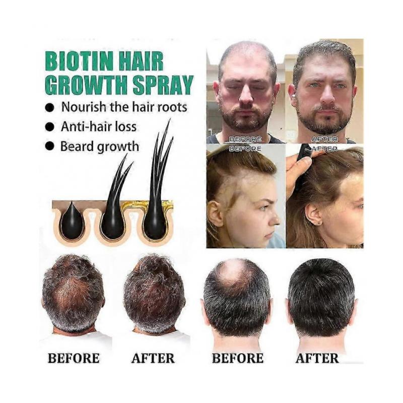 Biotin Hair Growth Spray Anti Hair Loss Fast Regrowth Scalp Treatment Serum