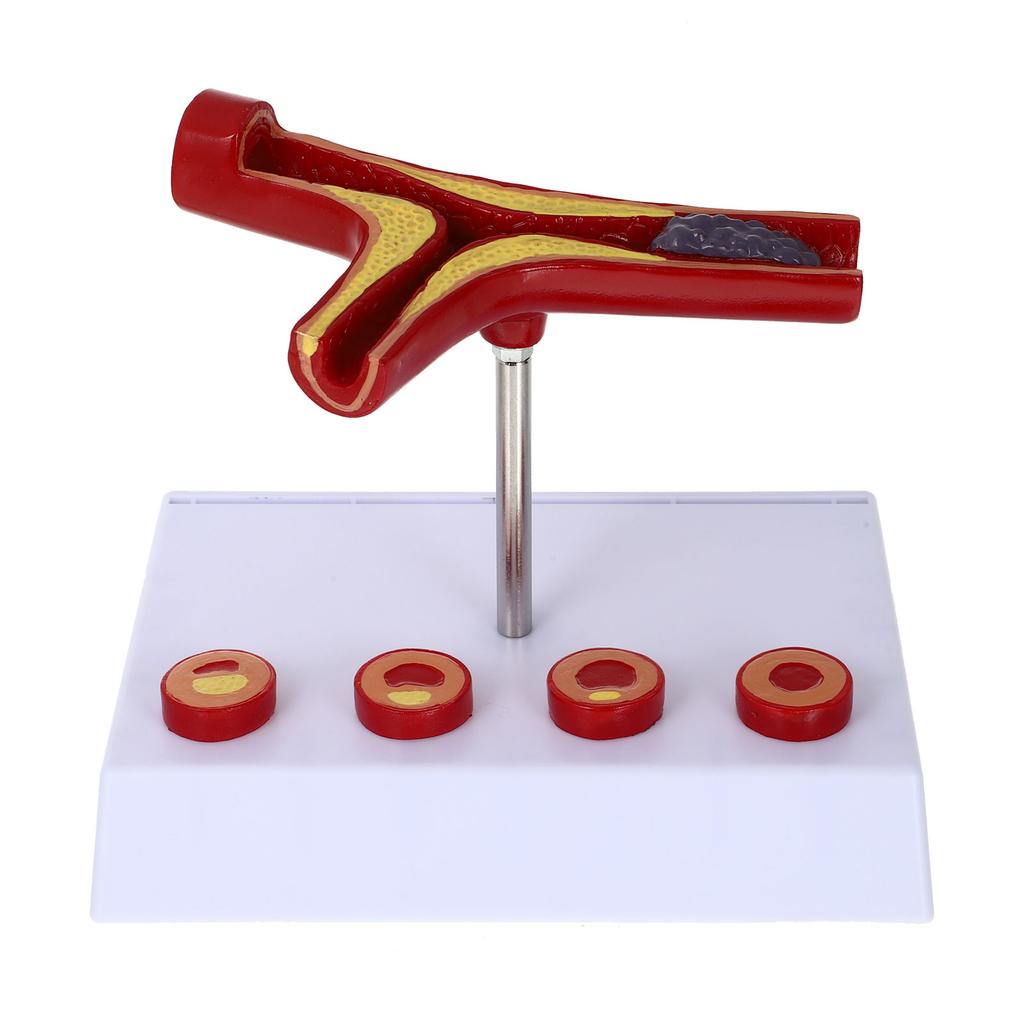 Pvc Cardiovascular Model Science Atherosclerosis Display Hospital Teaching Supplies Anatomical Models Physiology