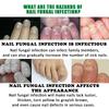 Fungal Nail Laser Device Toe Nail Fungus Removal Fast Repair Onychomycosis Toenail Fingernail Foot Care Cure Ingrown