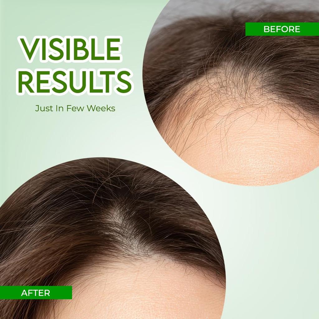 Jovees Herbal Rosemary Water Hair Care Mist Spray with Follicusan DP 200 Ml Scalp Nourishing Non Greasy Hair Tonic