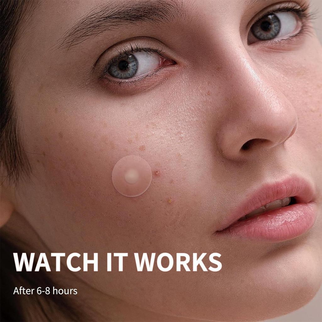 Acne Patch Large Capacity Pimple Patches, Cute Zit Covers,Hydrocolloid Acne Patches With Hyaluronic Sour 240pc