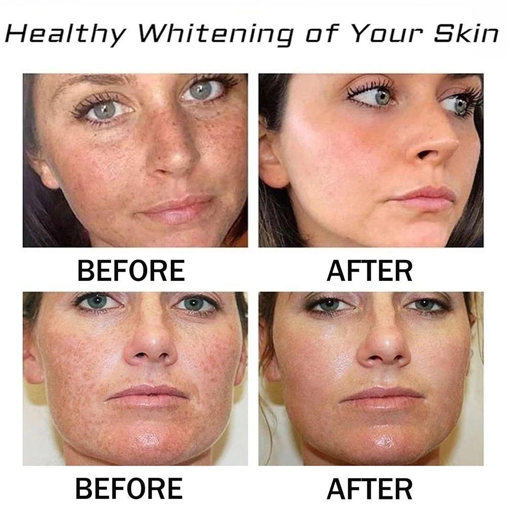 100ml Freckle Removal 377 Essence Oil Long-lasting Face Oil  For Face & Body