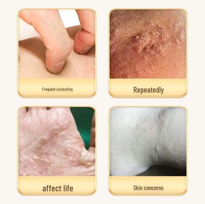 Japanese Dyshidrosis Anti-Itch Cream for Blisters & Athlete's Foot - Antibacterial Relief for Peeling & Itching Skin