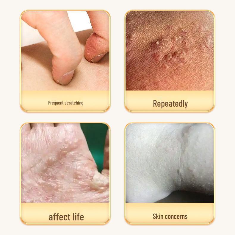 Japanese Dyshidrosis Anti-Itch Cream for Blisters & Athlete's Foot - Antibacterial Relief for Peeling & Itching Skin