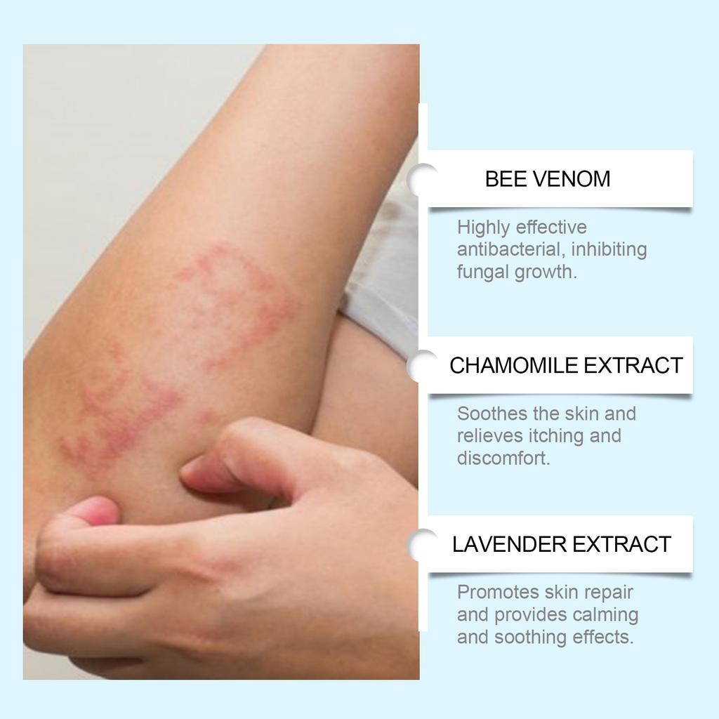 BeeAnti Fungal Cream,Fungus TreatmentCream, Itchy Skin Relief Cream,It Can Skin Ringworm Caused By Fungal .