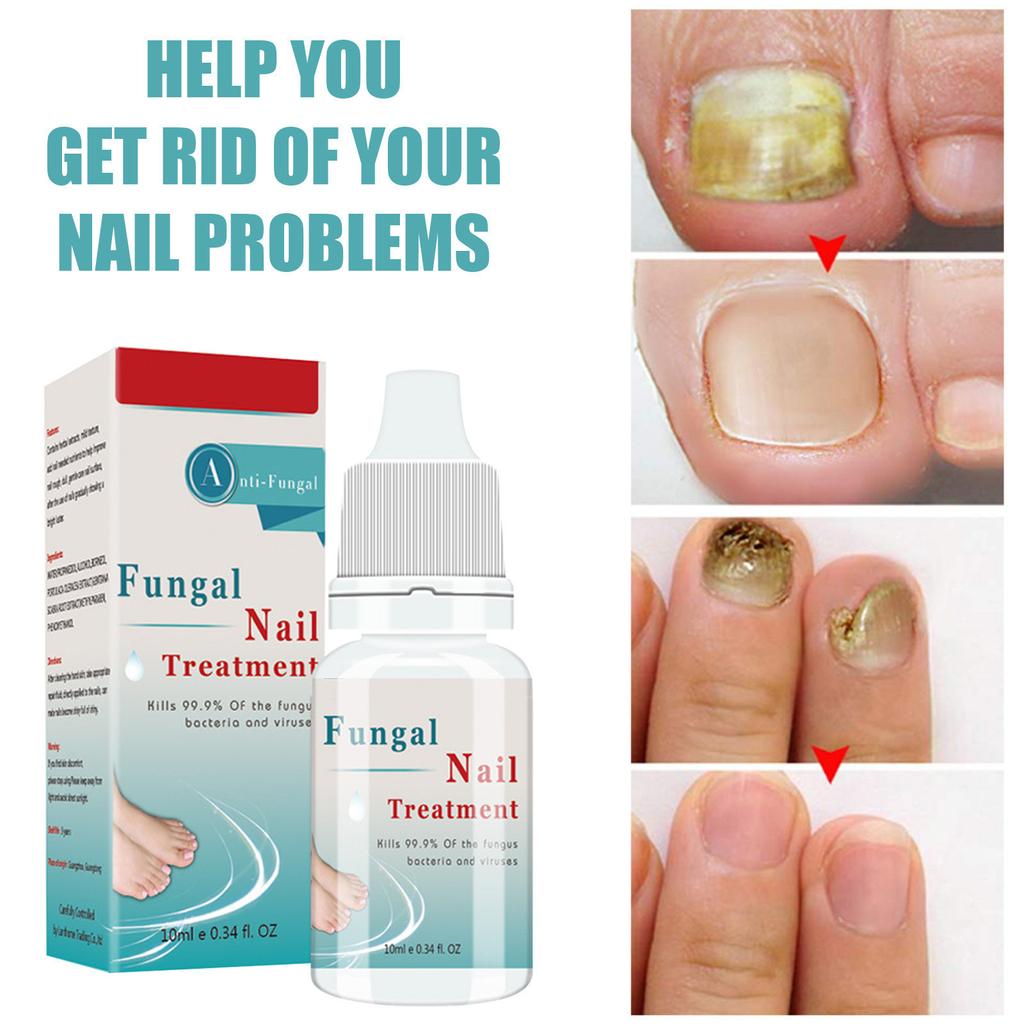 Nail Care Solution, Nail And Toe Care Solution, For Skin Care Nail Nourishing, Fungal Nail Liquid 10ml