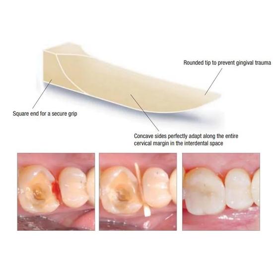 ET Dental Wooden Wedges Kit