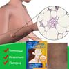 ZB Lipoma Patch Natural Herbal Lipoma Lump Removal Patches, Lipoma Removal Stickers 6pcs/bag