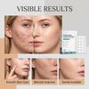 Microneedle Pimple Patches for Blemishes - Hydrocolloid Dots for Face