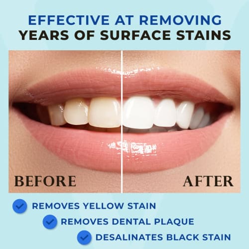 Venus Visage Award Winning Teeth Whitening Pen (2 Pens), 20+ Uses - Teeth Whitening Gel Professionally Formulated - Best Teeth Whitening Kit Teeth Whi