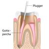 GDC Root Canal Plugger Luks -(.50mm) Rcpl2 #3
