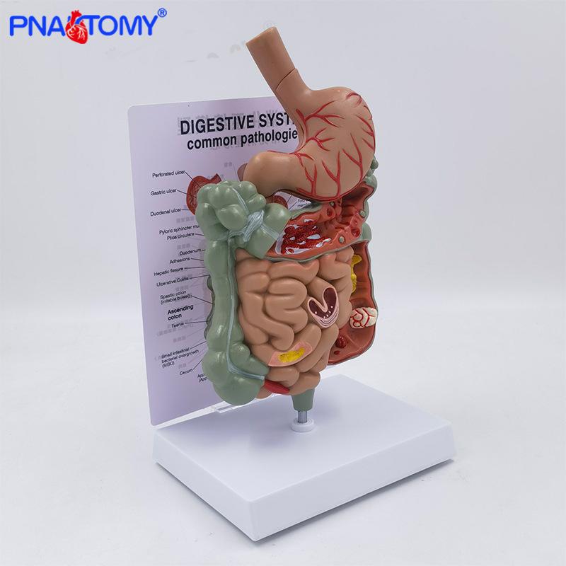 PNT-0767 Large Intestine Lesion Model for Intestinal Diseases 1:1 Scale