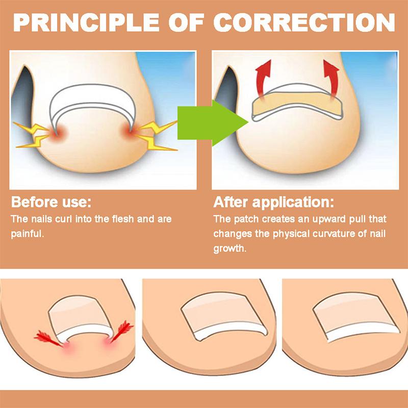 

60Pcs Ingrown Nail Correction Stickers Toenail Corrector Patches Paronychia Treatment Recover Corrector Pedicure Nail Care Tool