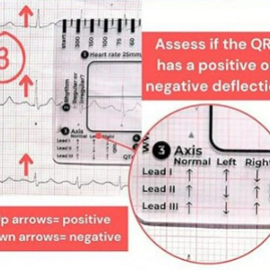 7-Step ECG Interpretation Ruler: Transparent Caliper Tool