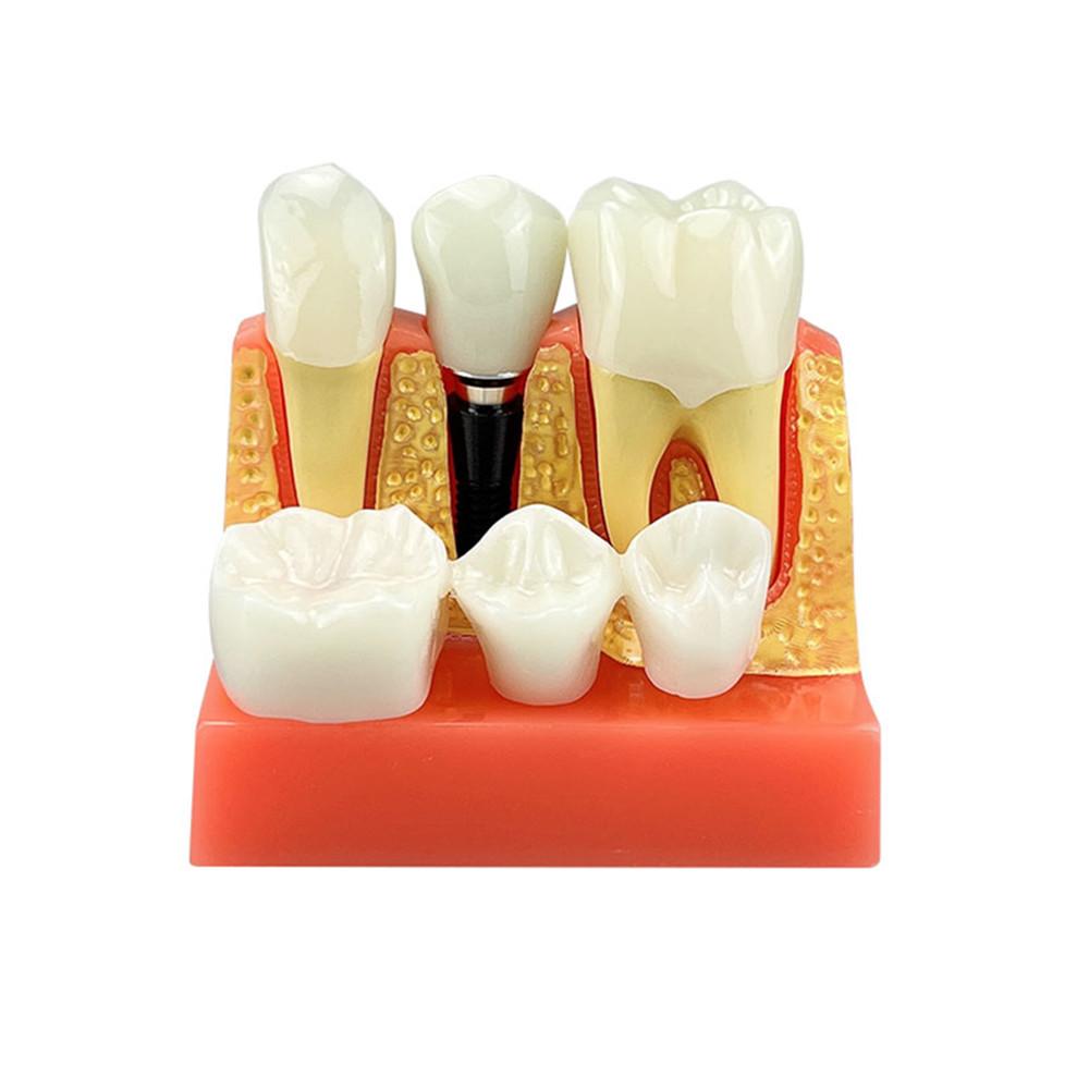 Modello Dimostrativo di Impianti Dentali 4 Volte Denti Analisi Impianti Corona Ponte Modello Rimovibile Per Studenti Dentisti Insegnamento Studio