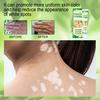 20 g White-Tag-Creme, einzigartige Verwendung von Pflanzenextrakten, therapeutische Vitiligo-Creme