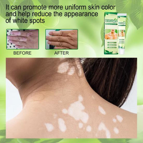 20 g White-Tag-Creme, einzigartige Verwendung von Pflanzenextrakten, therapeutische Vitiligo-Creme