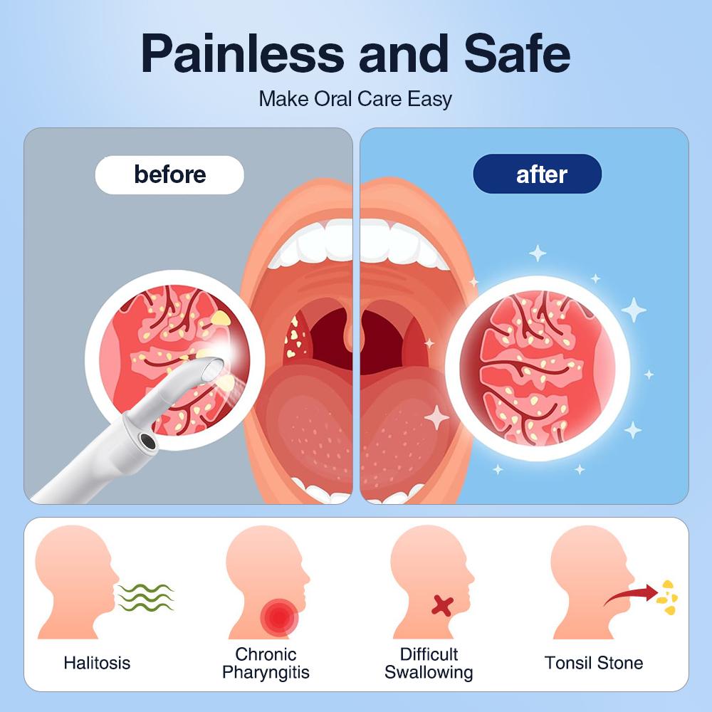 Electric Visual Tonsil Stone Remover Kit with 3 Suction Modes UV Disinfection Oral Care Mouth Cleaning Tool for Tonsil Stones