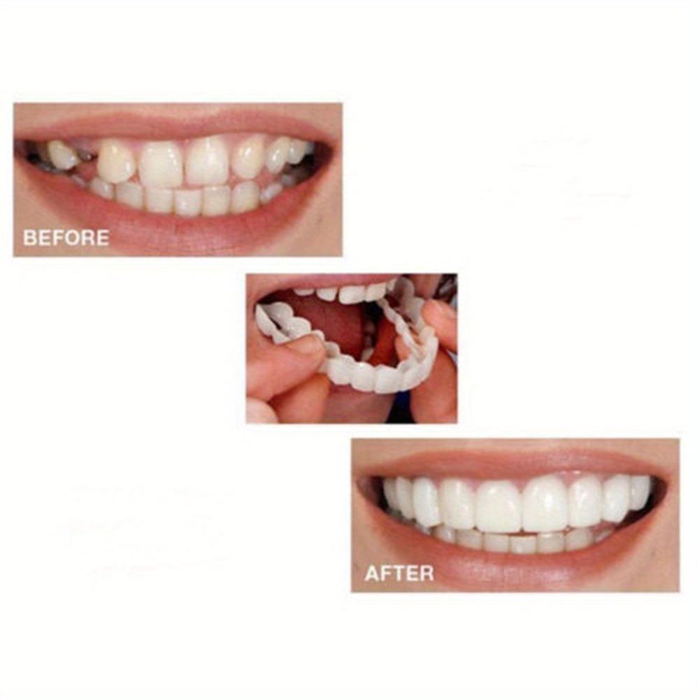 Two Pairs of Replacement Denture Accessories, White Denture Veneer To Fill Interdental Holes, Suitable for Men and Women