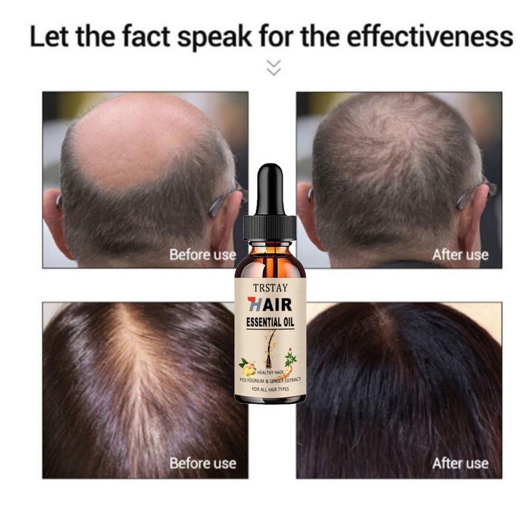 5ML/15ML/30ML/50ML Efficient Hair Care for Men and Women, Anti Damage Dry Repair, Scalp Oil Beauty Care, Prevention of Hair Loss Oil, Scalp Care