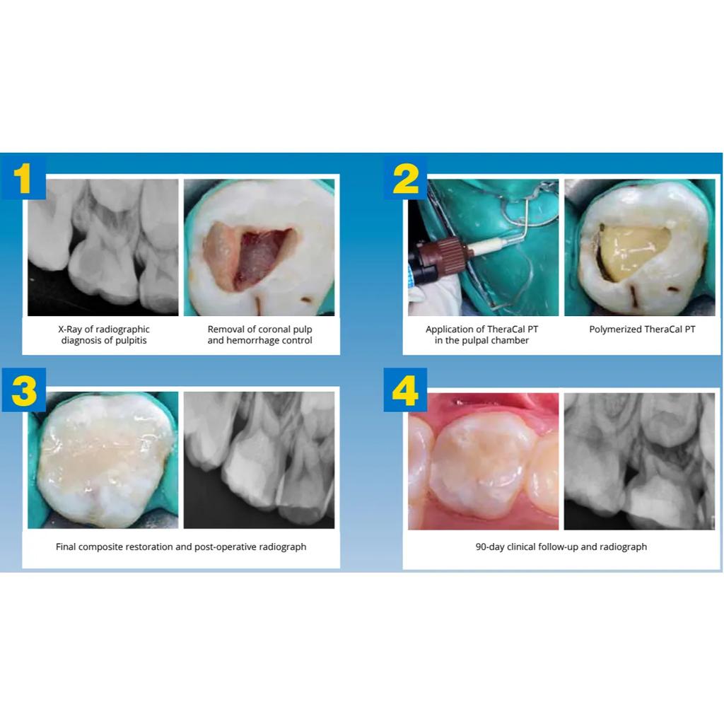 Bisco TheraCal PT DC Resin Modified Calcium Silicate Material MADE IN USA