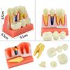 Dental Teach 4 Times Implant Analysis Crown Bridge Removable Model Dental Demonstration Teeth Model Dentisty Lab Material