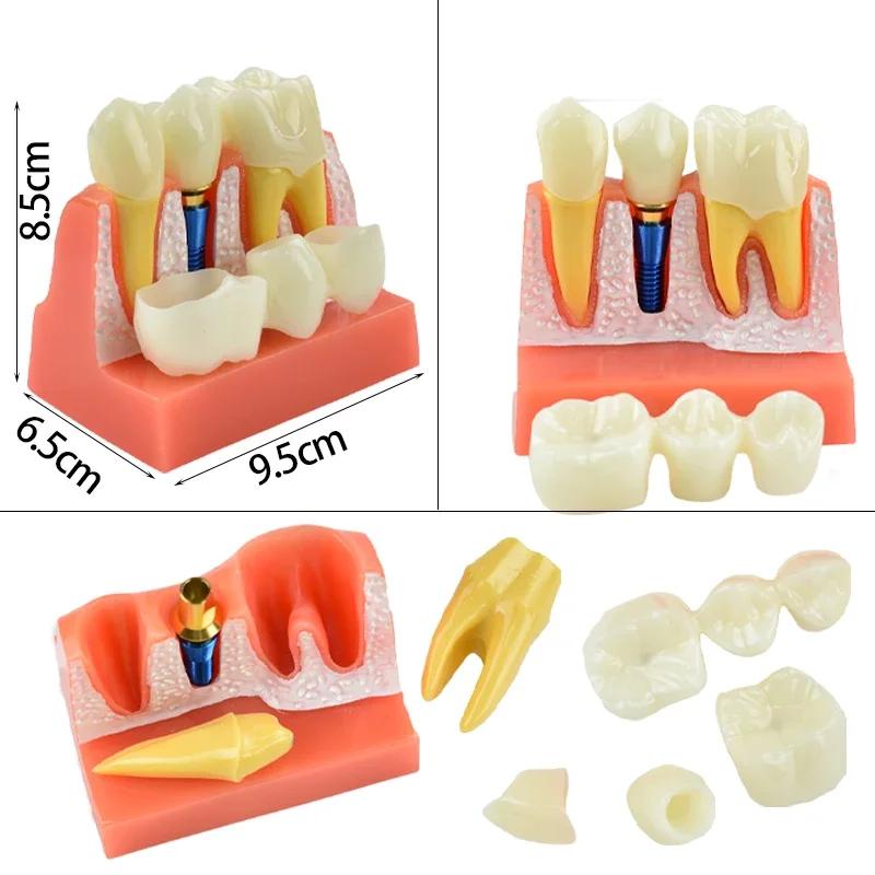 Dental Teach 4 Times Implant Analysis Crown Bridge Removable Model Dental Demonstration Teeth Model Dentisty Lab Material