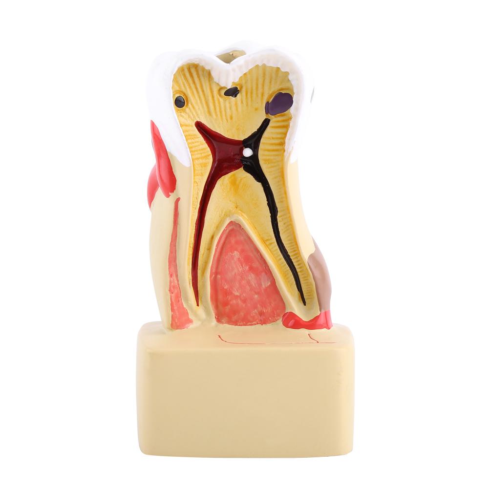 

1 шт. Стоматологическая комплексная патологическая болезнь Кариес Учебная модель зуба для изучения