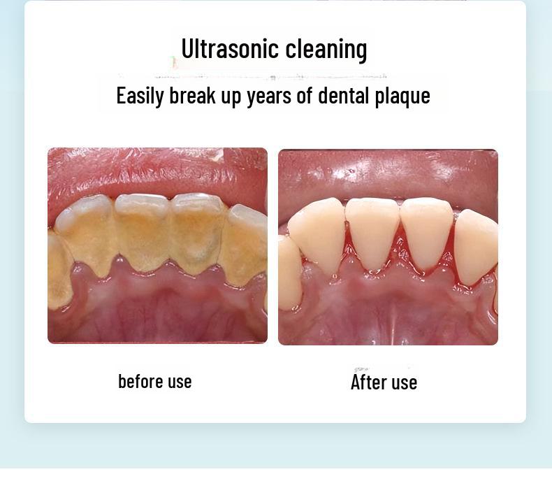 Nettoyeur de dents à ultrasons: Éliminateur de tartre, de taches et de plaque dentaire à trois vitesses pour le blanchiment des dents