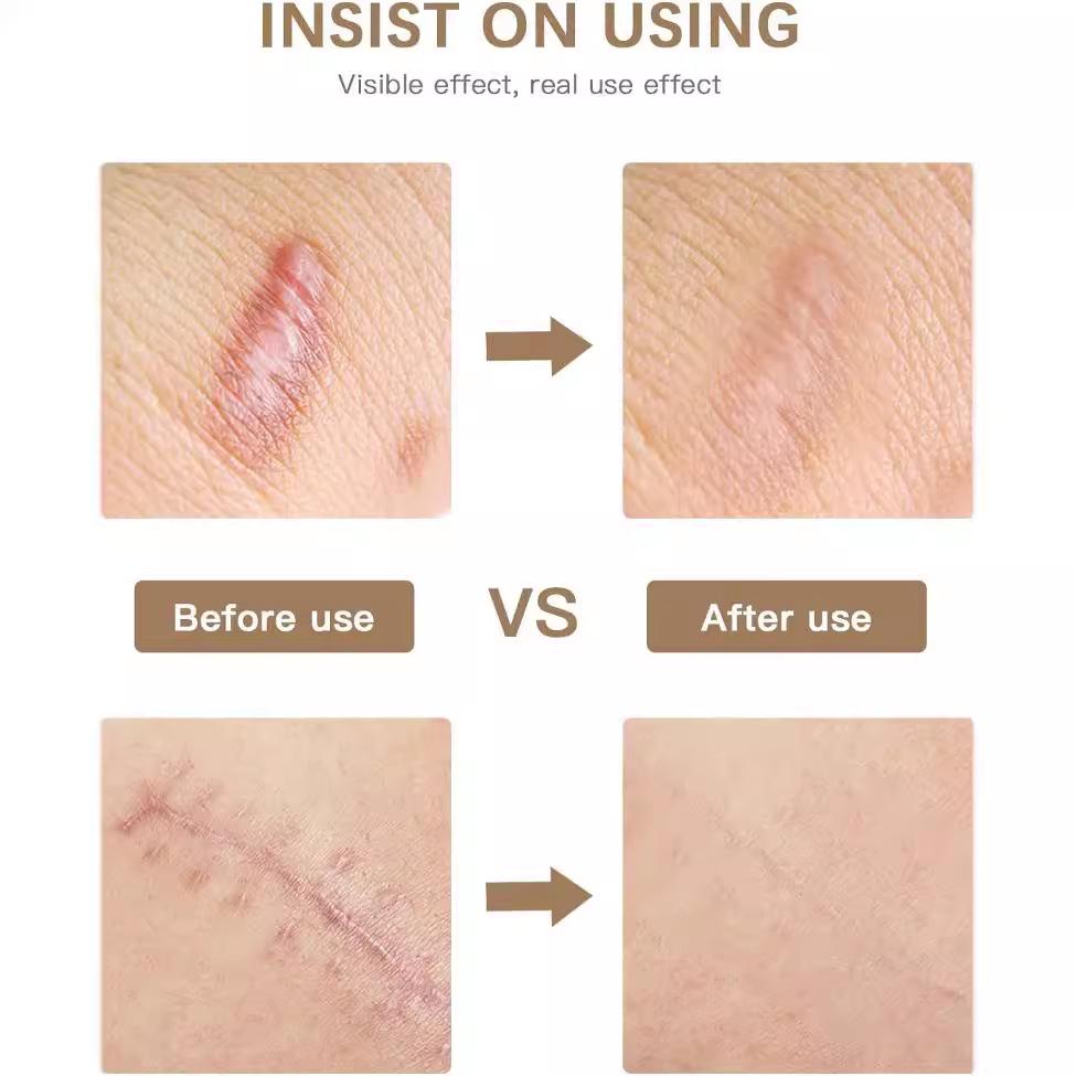 Silicone Scar Tape: Reusable Silicone Gel Sheets and Tape Roll