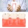 Dental Caries Model Tooth Decay Demonstration Model Simulation Detachable Teeth Model