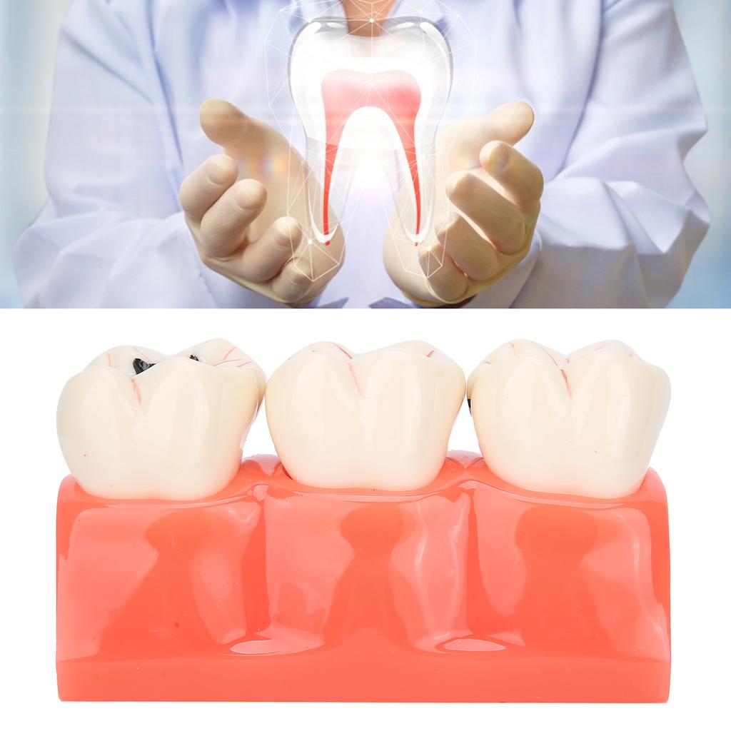 Dental Caries Model Tooth Decay Demonstration Model Simulation Detachable Teeth Model