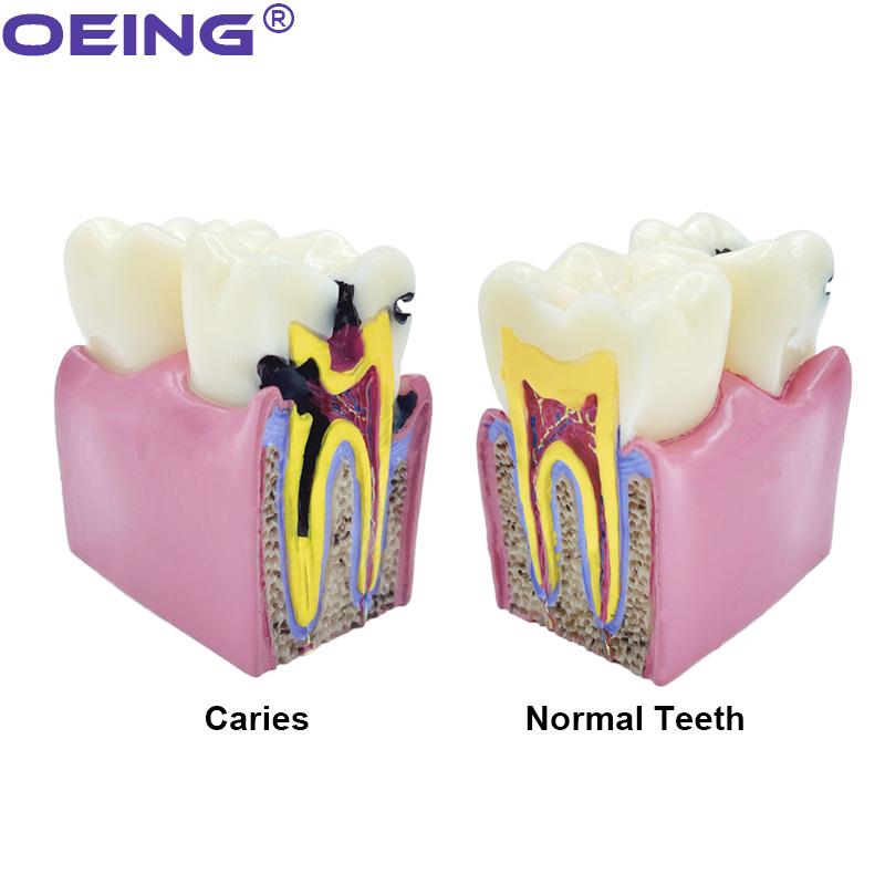 OEING 1Pc Dental Teaching Teeth Model 6 Times Dental Caries Model For Dental Demonstration Model Lab Oral Research Tool