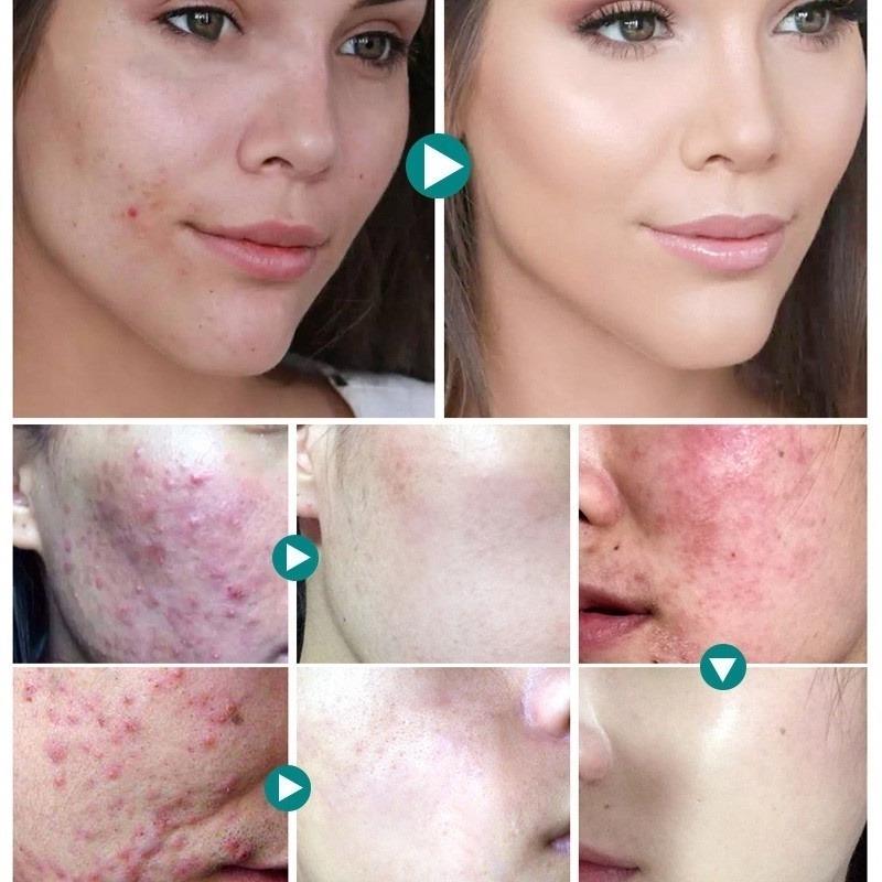 anti pimple face cream