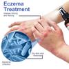 Eczema Therapy Spray-Eczema Treatment-Reduce Itchness And Redness-Prompte New Skin Cell Renewal, 100ml