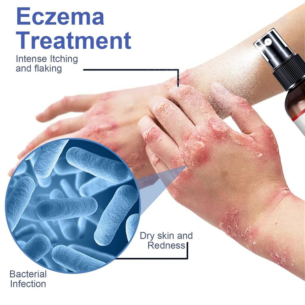 Eczema Therapy Spray-Eczema Treatment-Reduce Itchness And Redness-Prompte New Skin Cell Renewal, 100ml