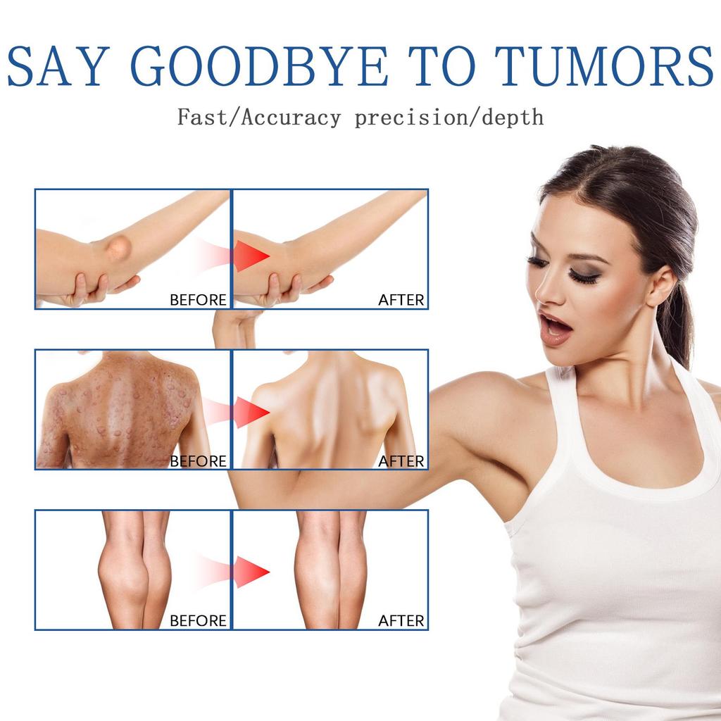 South Moon Fatty Knot Cream Fat Bump Relief Tumor Elimination Cream Lump Hardness Improvement Fatty Knot Cream