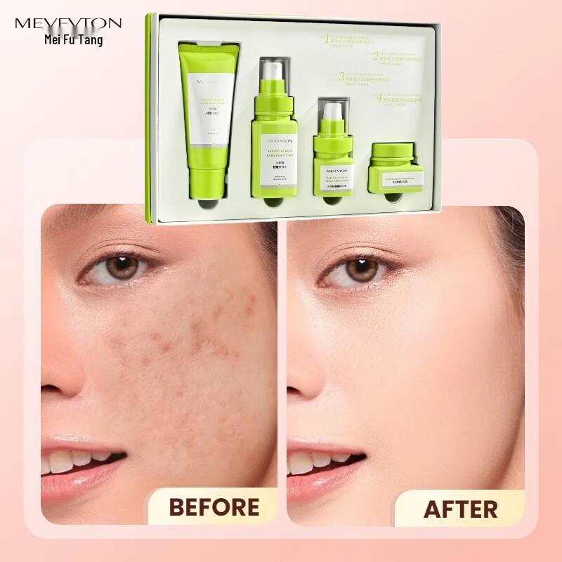 Meifutang Salicylic Acid 4-Piece Acne Skin Care Set