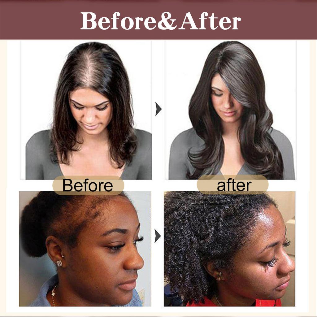 For Hair Growth Natural  Organic From Prevent Hair Loss And Enhances Hair Thicknesshair Care Enhancement Oilhair Oil30ml