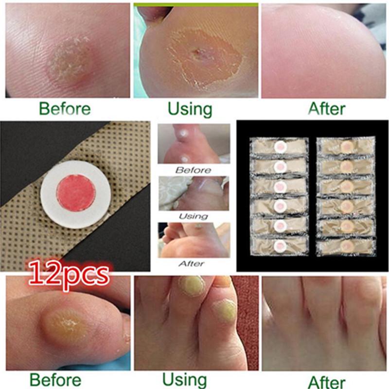 

12pcs Ноги ног кукурузы мозоли подошвенные бородавки Торн рельефа Инструмент наклейка