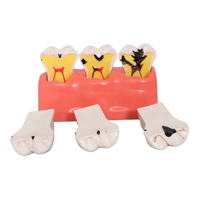 Dental Implant Teaching Model & Toothbrush Preparation Resin Mold