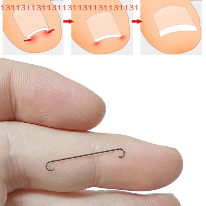 Ingrown Toenail Corrector Tools Pedicure Recover Embed Toe Nail Professional Ingrown Toenail Straightening Clip Brace