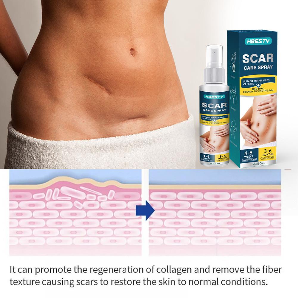 Hbesty Scar Spray Advanced Care For Postsurgical And Burn Recovery Suitable For All Types Skin